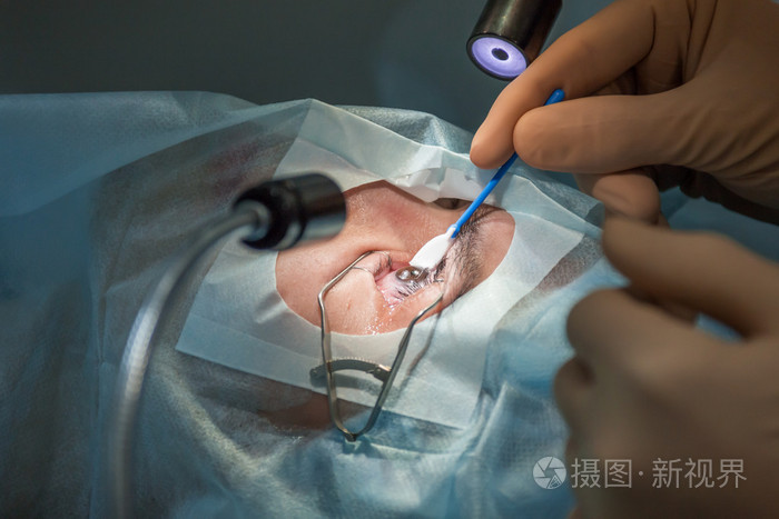 在lasik手术中皮瓣抬高. (7枪中的一枪)