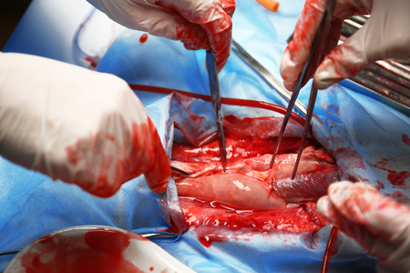 医生做心脏手术照片