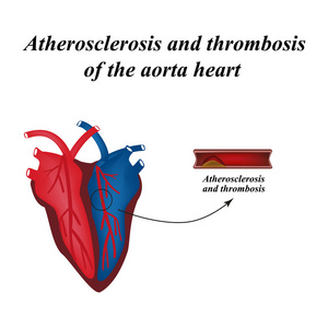 动脉粥样硬化和血栓形成的心脏动脉。信息图表。矢量图