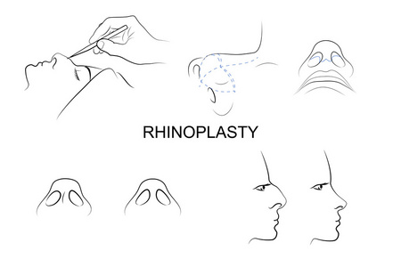塑料的鼻子。整容手术