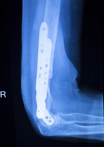 外科植入物的胳膊肘 x 射线测试扫描