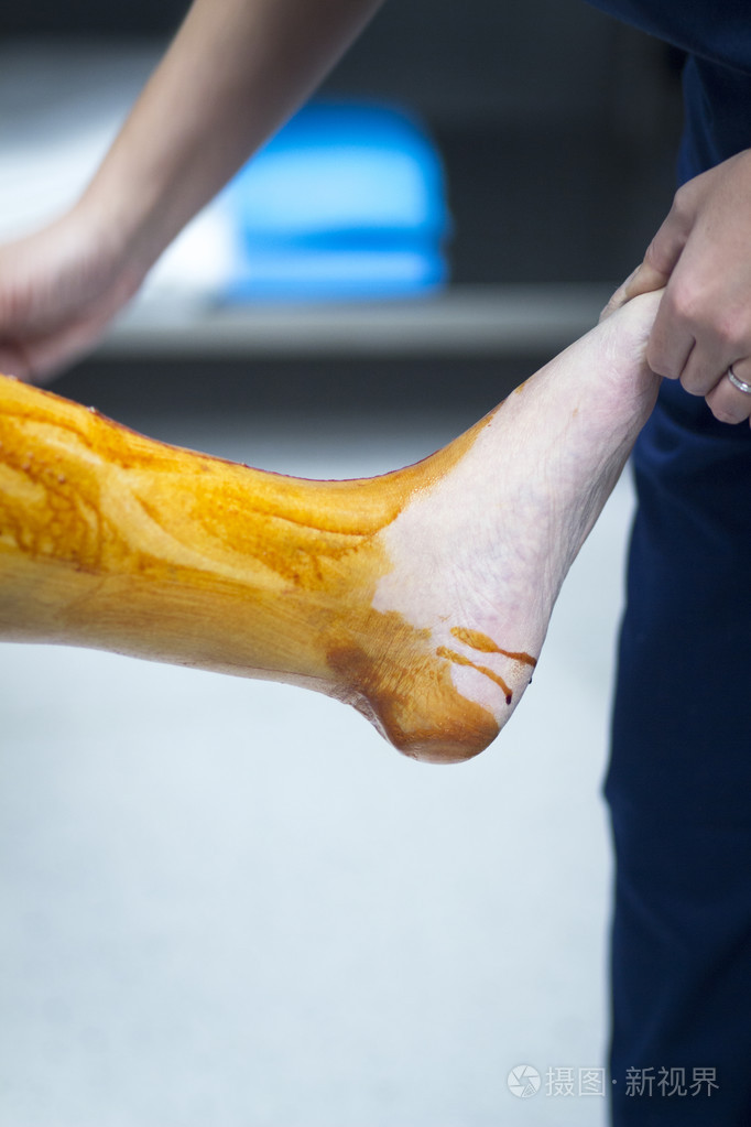 骨科膝关节手术消毒腿