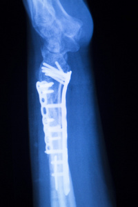 手骨科 x 线扫描