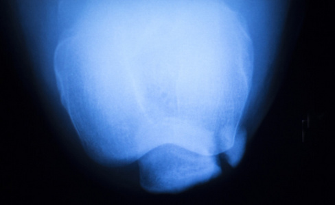 膝关节半月板损伤 x 射线测试扫描