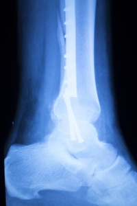 脚的脚踝和小腿 x 射线扫描