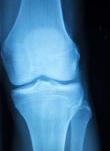 膝关节半月板损伤 x 射线测试扫描