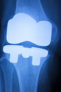 膝盖关节植入物的 x 射线测试扫描