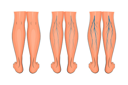 静脉曲张的下肢照片