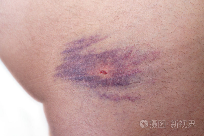 屁股附近擦伤的特写镜头