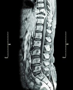 脊柱转移癌症扩散到胸椎MRI
