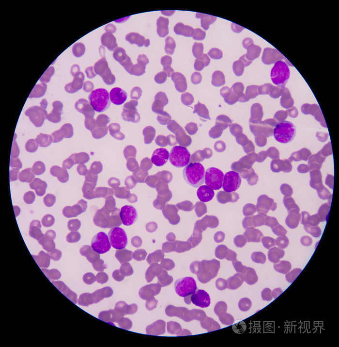涂片显示大量的癌症白血病 cel