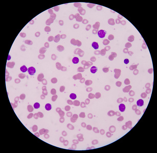 癌细胞x白血球肉图图片