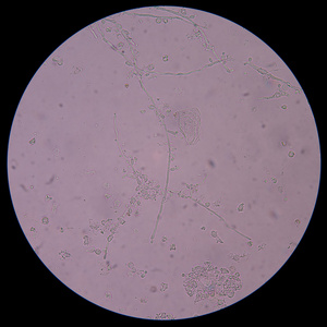 分枝萌芽与尿中的假菌丝的酵母细胞