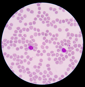 血小板减少症图片-血小板减少症素材-血小板减少症插画-摄图新视界