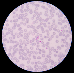 疟疾寄生虫血液涂片薄膜疟疾寄生虫阳性照片