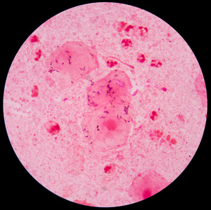 红白细胞痰革兰氏染色，细菌