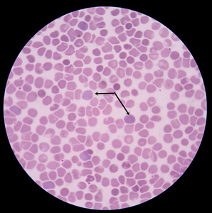 多色是一种障碍那里有血红细胞的数量异常的高
