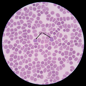 红细胞高渗图片