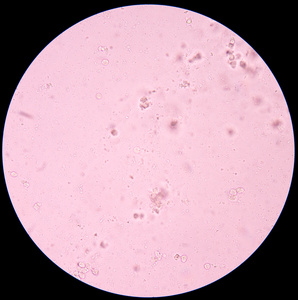 新鲜的细菌在尿液分析照片