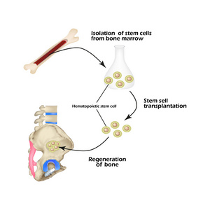 干细胞用于骨组织再生。信息图表。矢量图