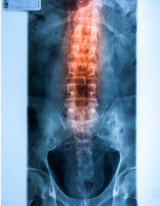 X 射线 Mri 图像的脊柱颈部疼痛