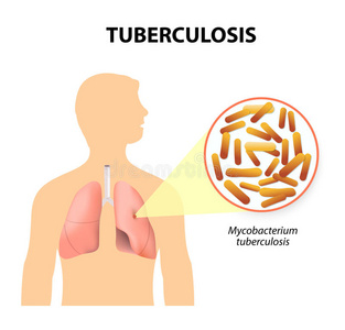 结核病结核分枝杆菌或结核病