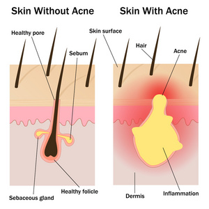 皮肤与无痤疮