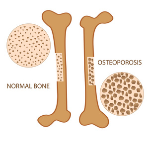 骨质疏松症骨解剖