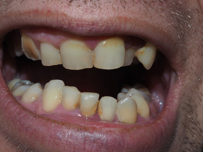 病人的患病牙齿照片