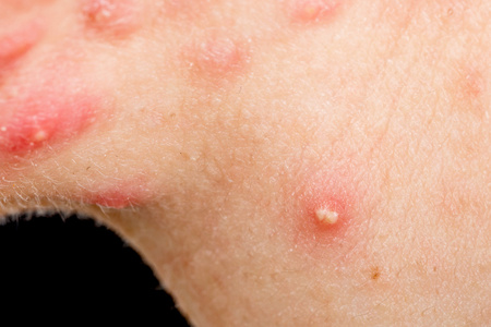 激素痘结节囊肿性痤疮皮肤照片