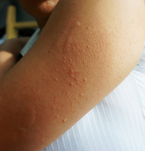 手臂皮肤过敏性皮疹皮炎照片