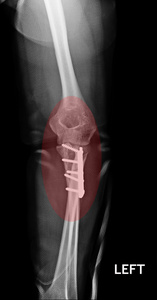 骨折肘 前臂的 x 射线图像显示板和螺丝固定