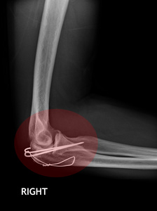 骨折肘 前臂的 x 射线图像显示板和螺丝固定