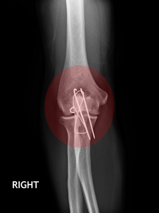 骨折肘 前臂的 x 射线图像显示板和螺丝固定