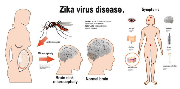 Zika 病毒症状