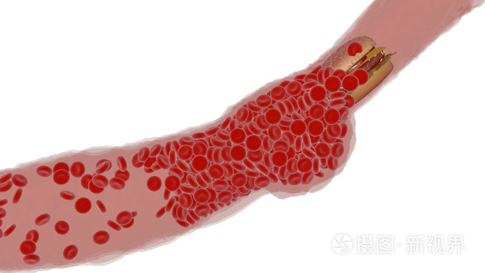 阻塞的动脉血小板与胆固醇斑块，肥胖的健康风险的概念