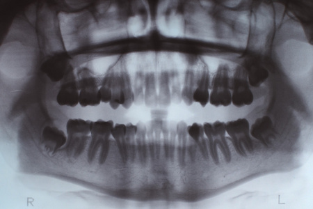 x 射线的牙齿