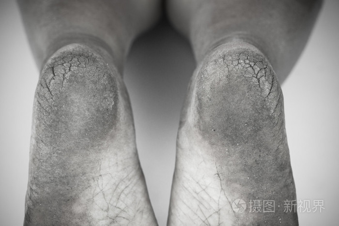 单色或背部和白色的脏脚或对白色背景,医疗或脚健康