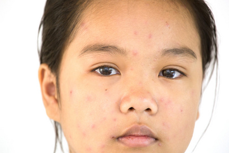 脸部长痘夫人对不满的脸上的水痘照片