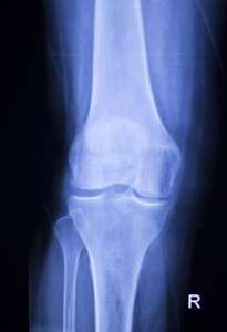 膝关节半月板损伤 x 射线扫描