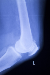 膝关节半月板损伤 x 射线扫描