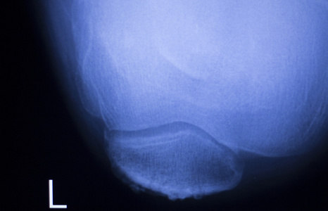 膝关节半月板损伤 x 射线扫描