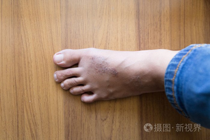 女人的皮肤脚上的皮疹湿疹