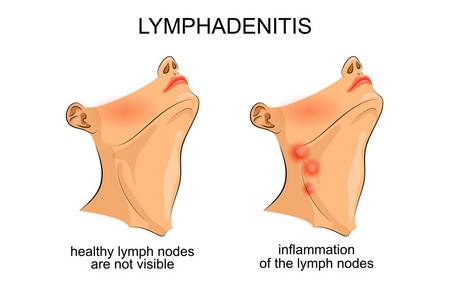 淋巴结炎。淋巴结的炎症