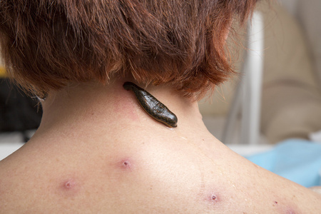 治疗的医学水蛭人照片