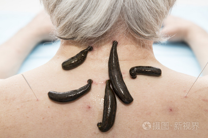 治疗的医学水蛭人