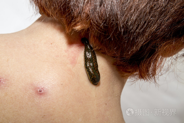 治疗的医学水蛭人