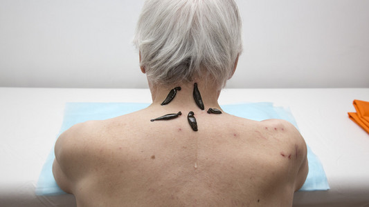 螨, 水蛭, 孤立的彩色矢量插图白色背景治疗的医学水蛭人一次水蛭疗法