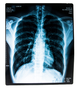 人体胸部的 x 射线图像
