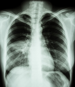 肺炎胸片显示右m肺泡浸润